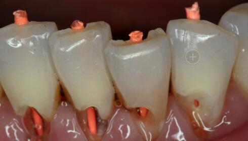 牙齿边缘有缺口图片,牙齿上面缺口