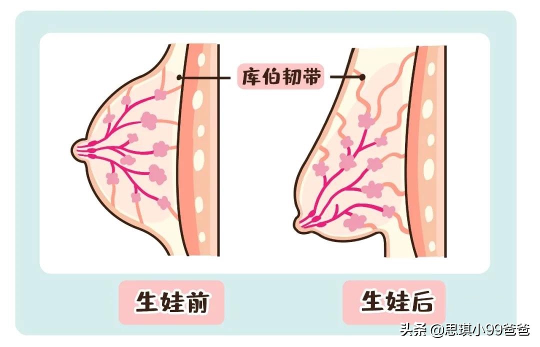 胸下垂是因为母乳的原因吗,胸下垂怎么哺乳