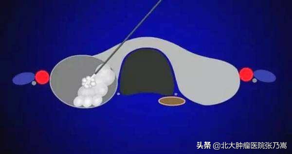 北京肿瘤医院甲状腺结节专家推荐,北大肿瘤医院甲状腺手术好约吗