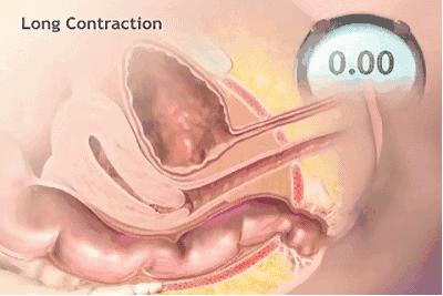 产后下垂要做盆底肌修复吗,产后真的要做盆底肌修复吗