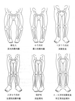 o型腿很难矫正吗,膝关节炎导致o型腿的原因