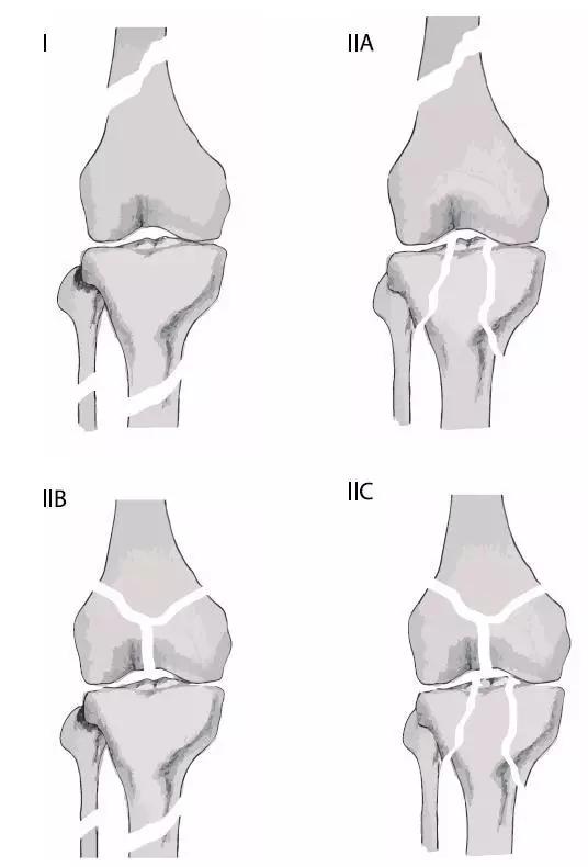 所有骨折都叫什么名字,骨折的名称有哪些