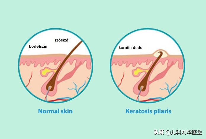 鸡皮状的皮肤病,鸡皮样的疹子是什么病