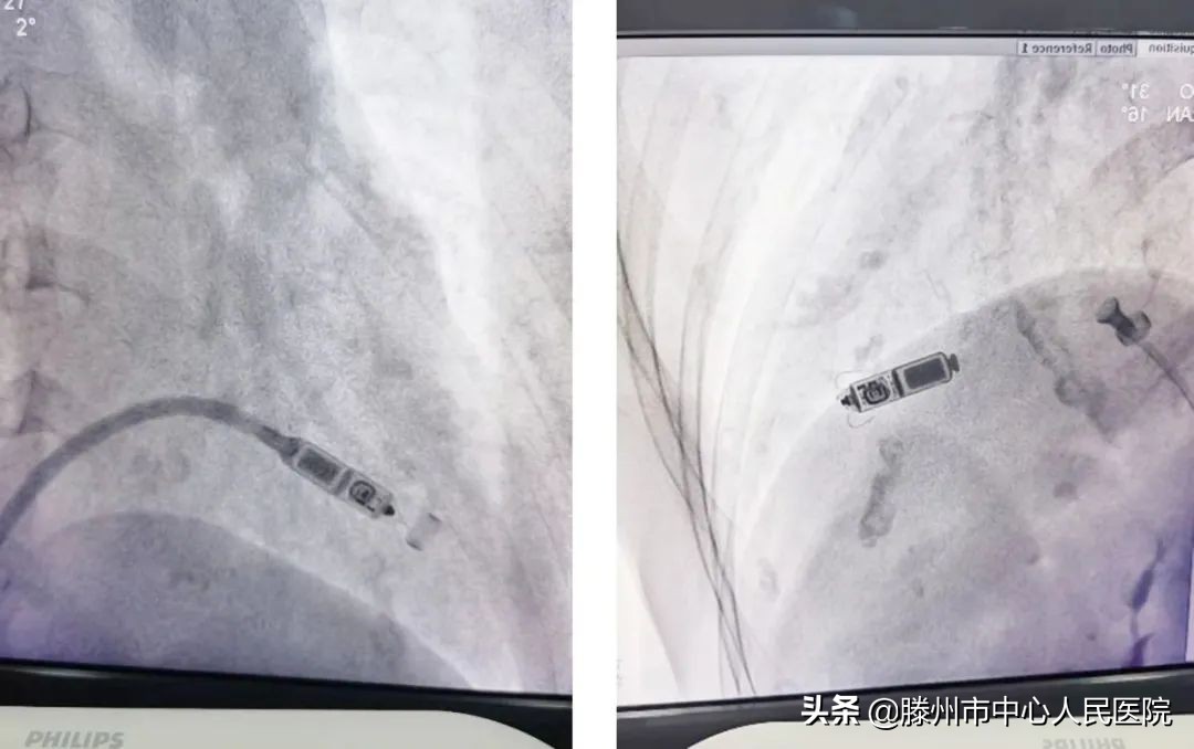 冠心病监护病房成功完成无导线心脏永久起搏器植入术