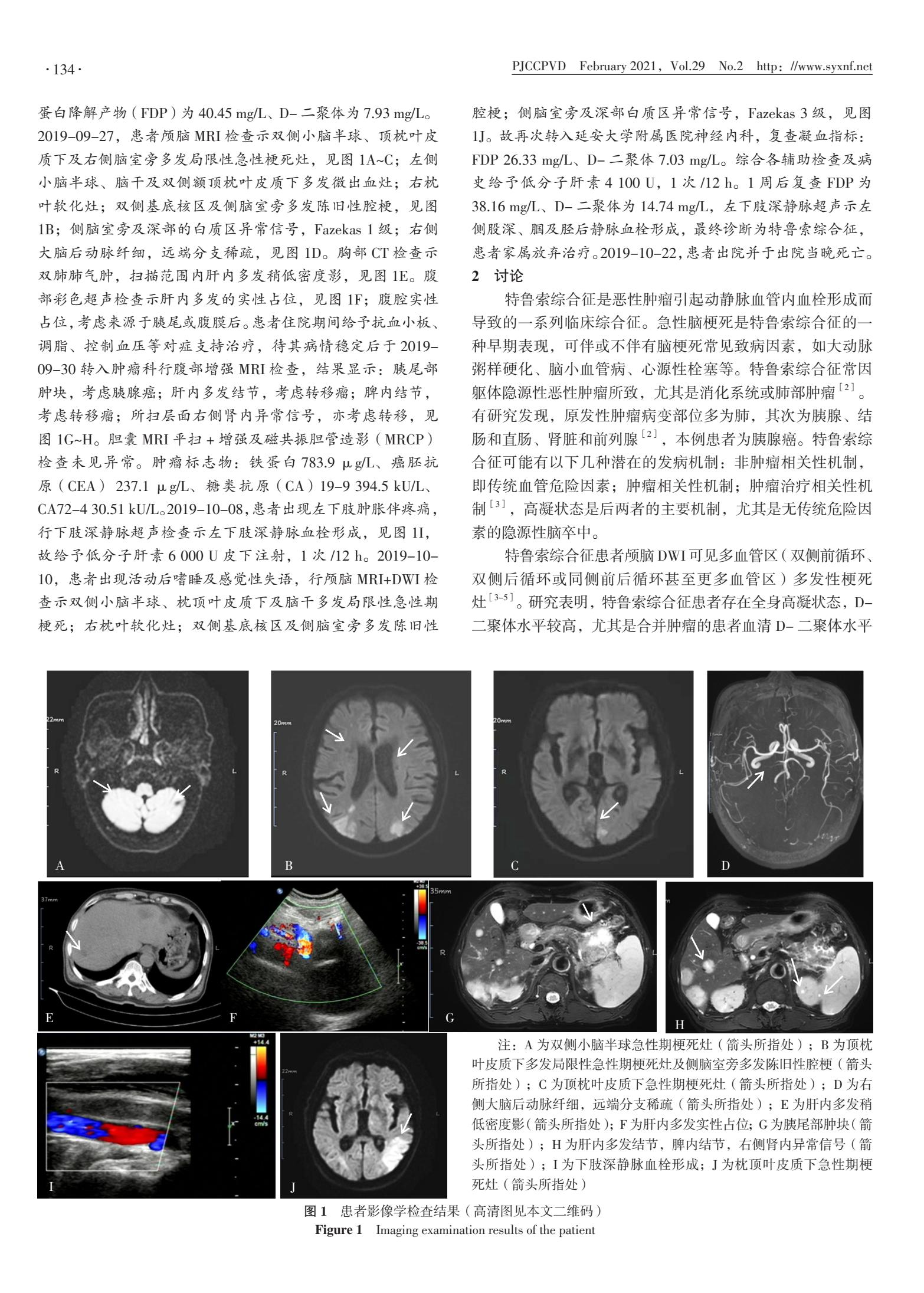 特鲁索综合征一例报道,特鲁索综合症患者的护理要点