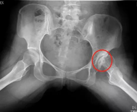 女性髋关节发育不良康复训练,35岁先天性髋关节发育不良修复术