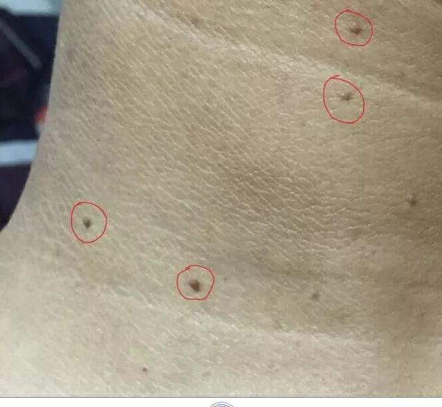 像老年斑一样的扁平疣怎么治,像斑一样的扁平疣