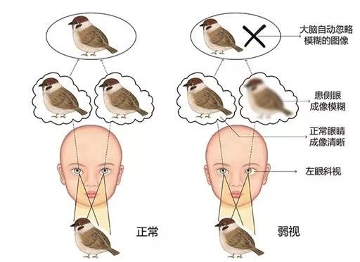 成人弱视斜视训练有用吗,专注儿童弱视斜视训练