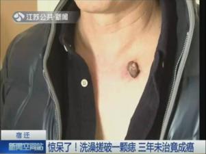 点痣可以阻止癌变吗,女孩点痣好了后面还会复发吗