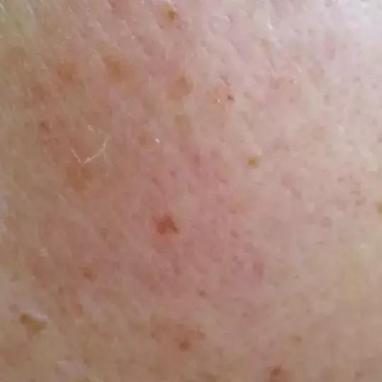 激光祛痣后悔吗,激光祛痣没掉反而更大