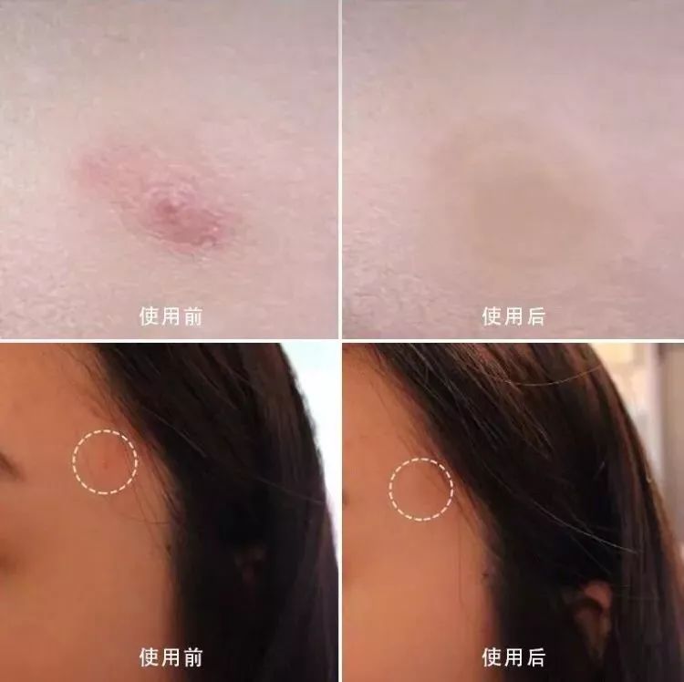 有效祛痘印的痘痘贴,祛痘痘的药膏明星