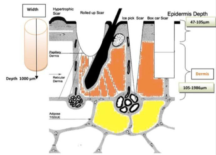 脸上痘印痘坑怎么消除最有效,痘坑怎么才能彻底解决