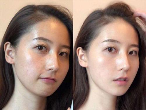 娲昏鍖栫榾鐨勪腑鎴愯嵂鍙互娣″寲鏂戠偣,娲昏鍖栫榾鍏婚鑽湁鍝簺