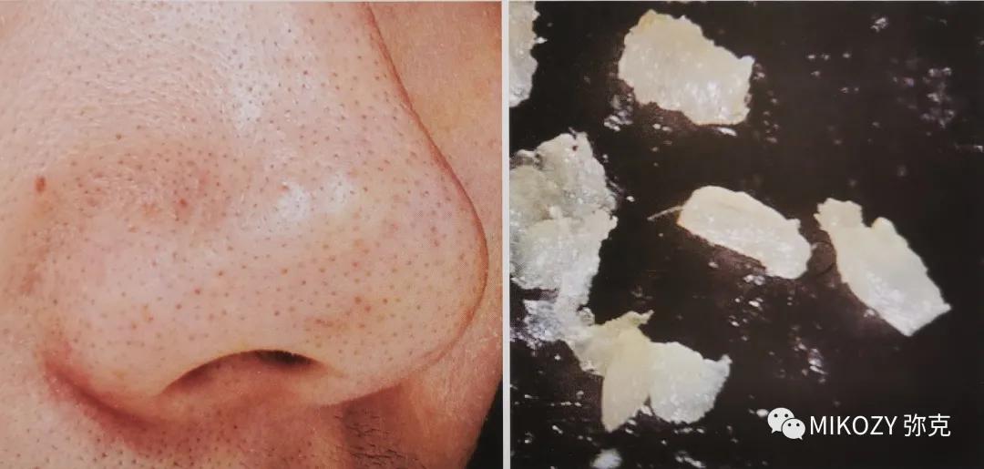 去除陈年深黑头,清理黑头哪家强