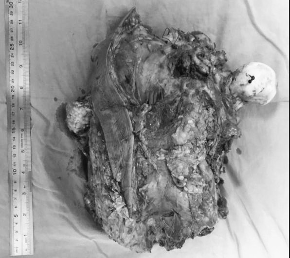 老人千里来深求医,切除巨瘤成功保肢!--市二医院骨科成功完成高难度巨大骨旁软组织肉瘤切除保肢术