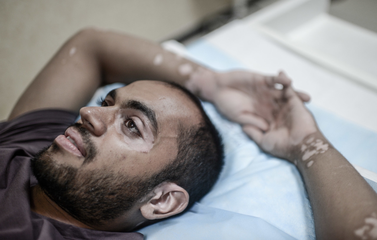 脸上有痘痘还有白癜风怎么办,脸上白癜风是不是更好治疗