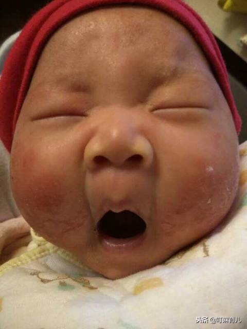 孕妈妈也会有黄疸吗,孕妈妈有湿疹对宝宝有影响吗