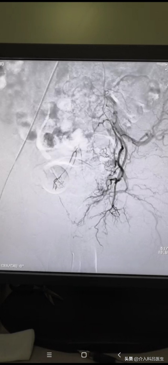 不死的癌症肠易激综合征,不死的癌症中医治疗