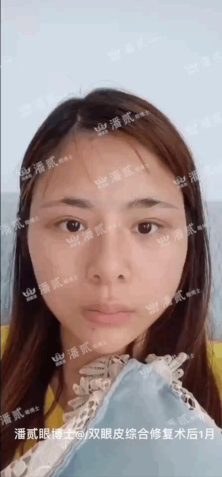 高难度修复双眼皮宽改窄恢复期,高难度双眼皮修复案例