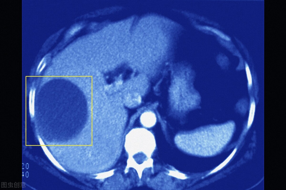 b超查出来肝囊肿要怎样治疗,肝囊肿发现有癌变时还可以治愈吗