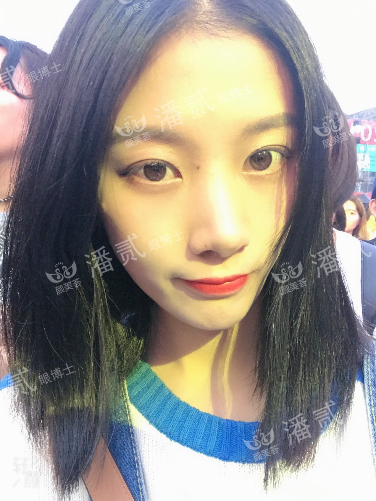 肿眼泡抽脂肪埋线双眼皮效果,肿眼泡割双眼皮长脂肪