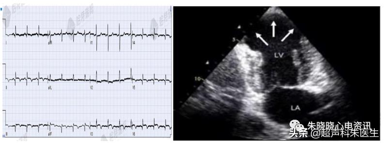 t波倒置诊断,t波倒置如何区分严重程度