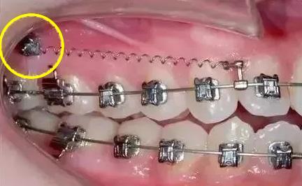 戴全瓷牙套全过程视频,戴牙套的亲身经历全过程