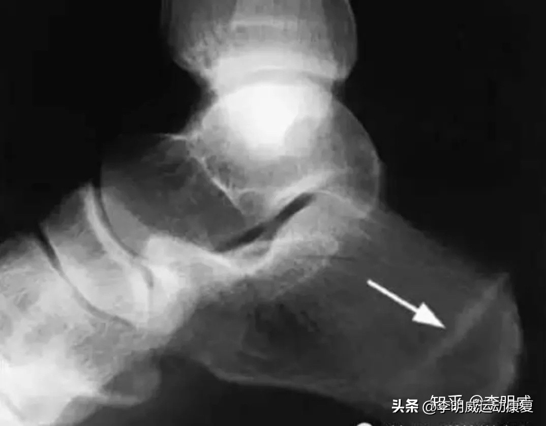 足跟痛的自我治疗方法,足跟痛艾灸的治疗方法