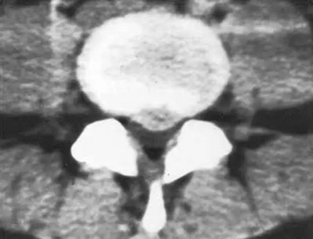 颈椎腰椎疾病ct及mri诊断,腰椎ct可以发现肠部病变吗