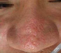 打败毛孔!下一个反孔精英就是你!