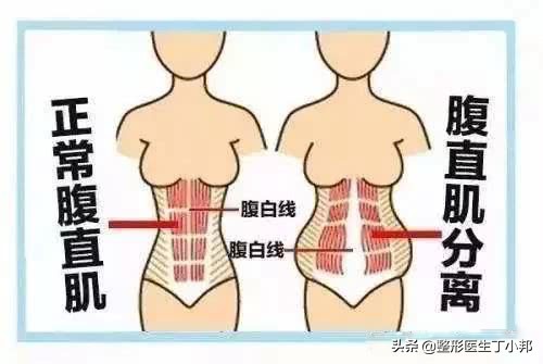 刚生完宝宝肚子有一块硬硬的,生了宝宝后肚子松弛怎么恢复