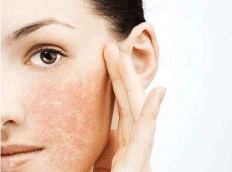 脸上过敏发红发痒肿怎么办最有效,脸上过敏发红还肿怎么办