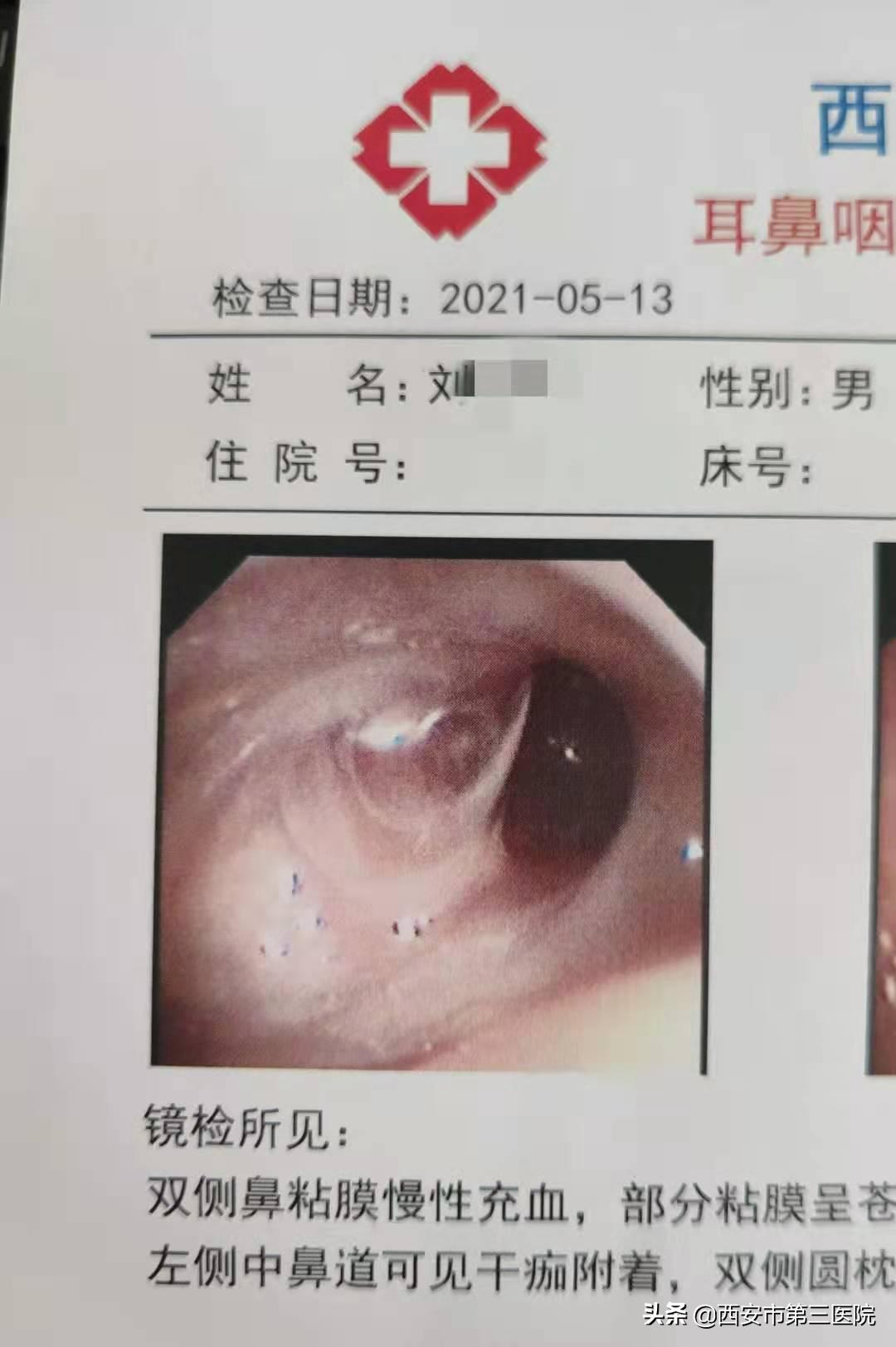 治愈鼻窦炎有好的方法么,鼻窦炎反复发作疼痛难以忍受