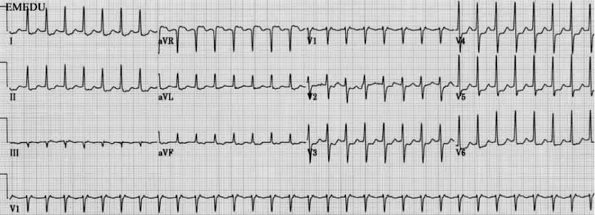 阵发性室上性心动过速注意事项,室性阵发性心动过速的处理方法