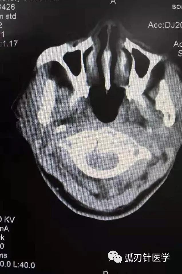 环枢椎错位，张口位X片显示环齿间隙左宽右窄，处理哪一侧？