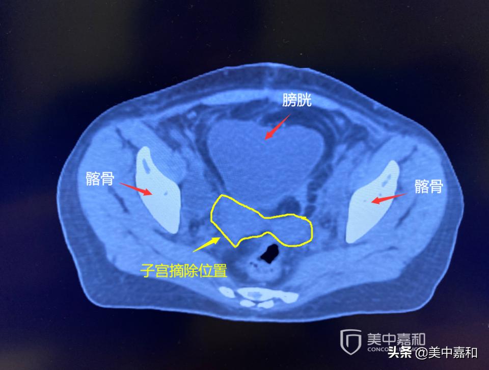 手术之后怎么能不留疤,前列腺癌4+3根治手术后怎样防复发