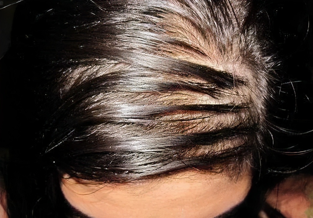 头发爱出油什么原因用什么洗发水,男士头发油掉发严重用什么洗发水