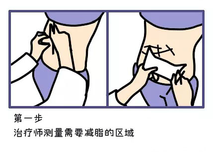 酷塑冷冻溶脂副作用是什么样的,酷塑冷冻溶脂的真实经历对比