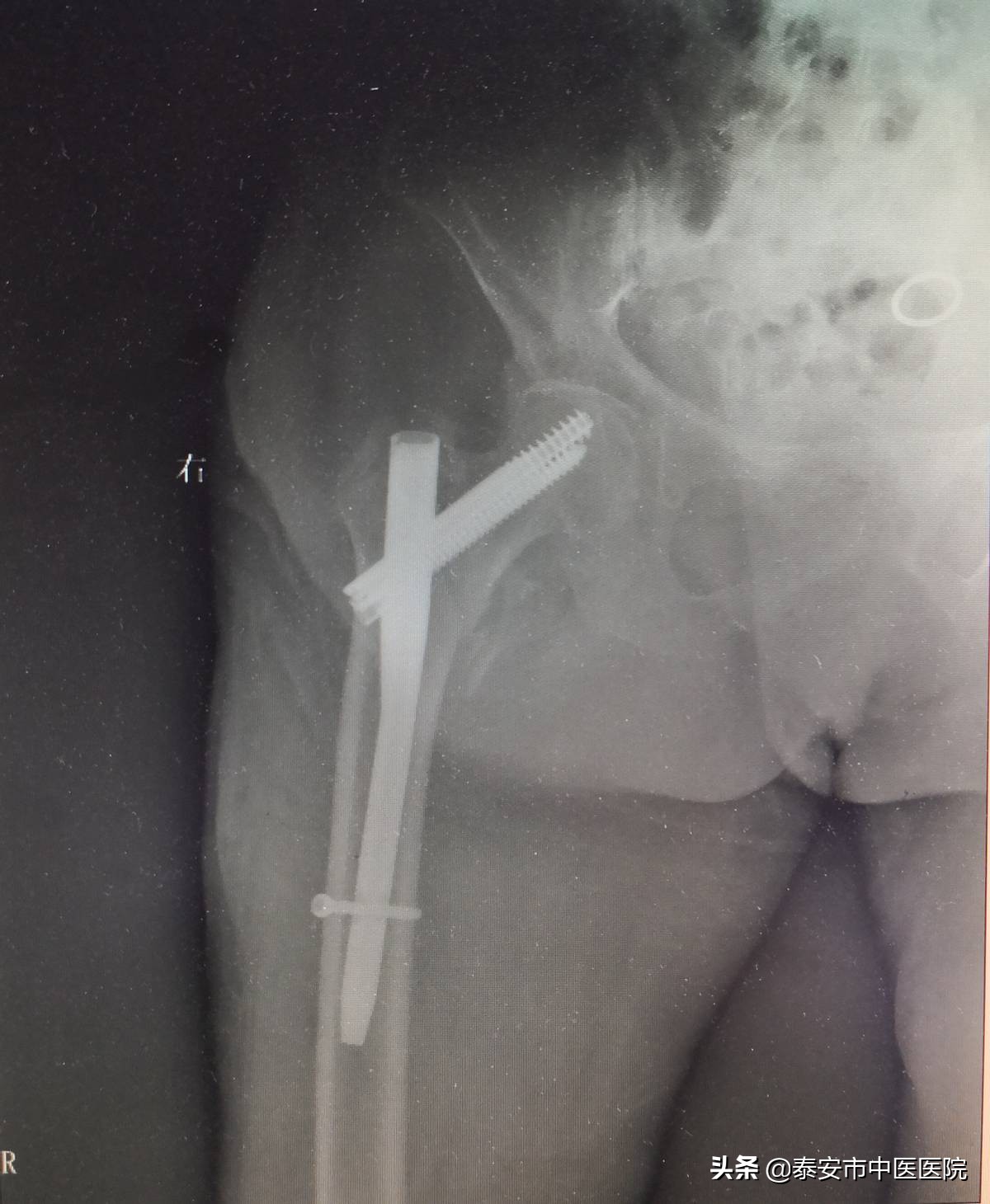 勇担健康新使命续写“骨伤”新担当——记*安泰**市中医医院（*安泰**市骨伤医院）创伤骨科、手足外科