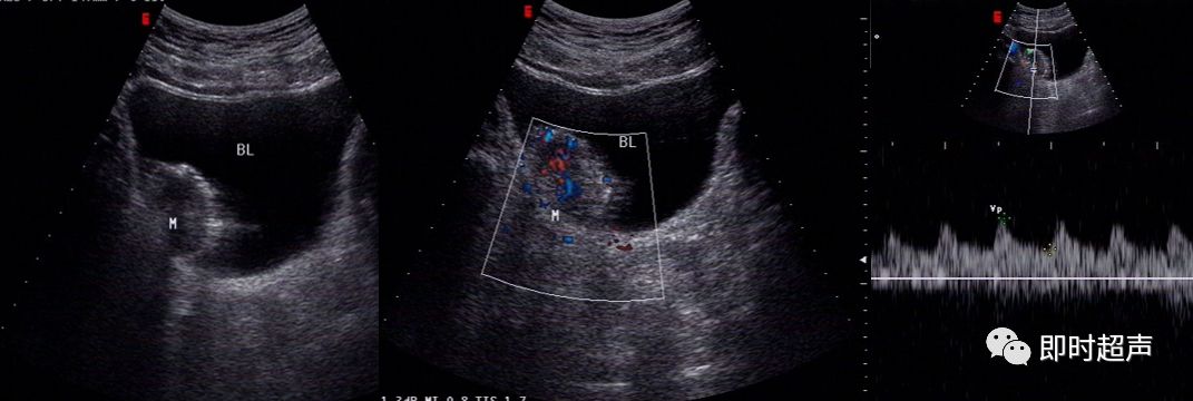 膀胱超声图解大全,膀胱超声解剖及常见病变超声表现
