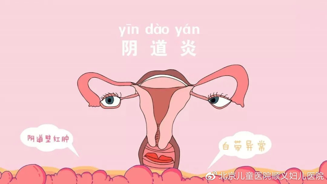 呵护女性私密健康远离难言之隐的阴道炎
