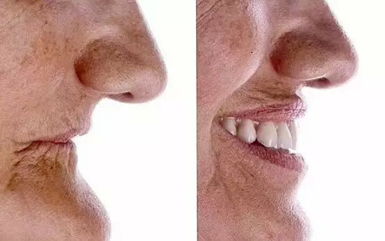 重度牙周炎是拔牙好还是治疗好,治疗牙周病需要拔除智齿吗