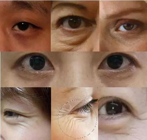 去眼纹去黑眼圈用什么方法,去眼袋黑公认最好用的土方法