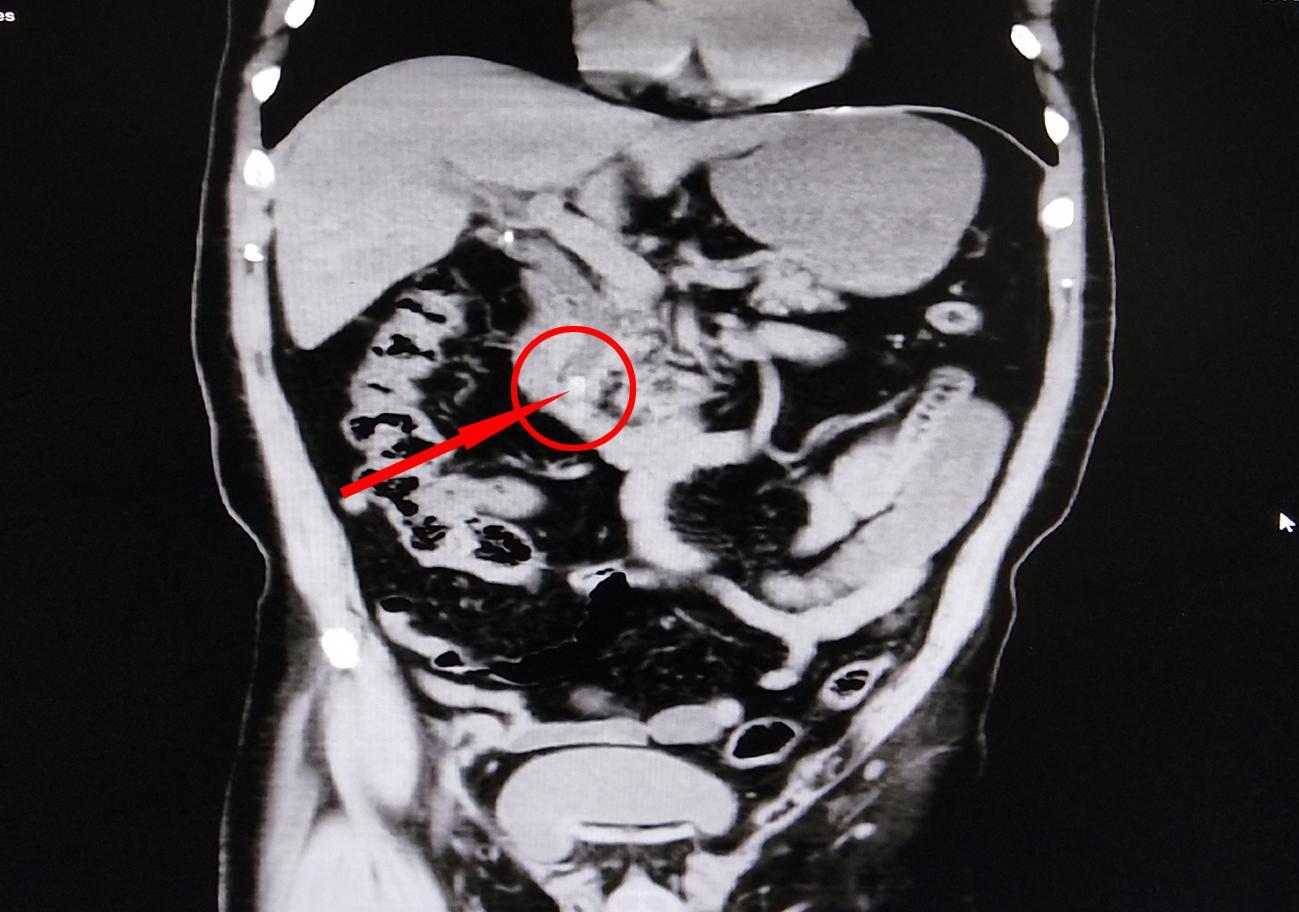 无创切除胆囊,无创取胆囊结石