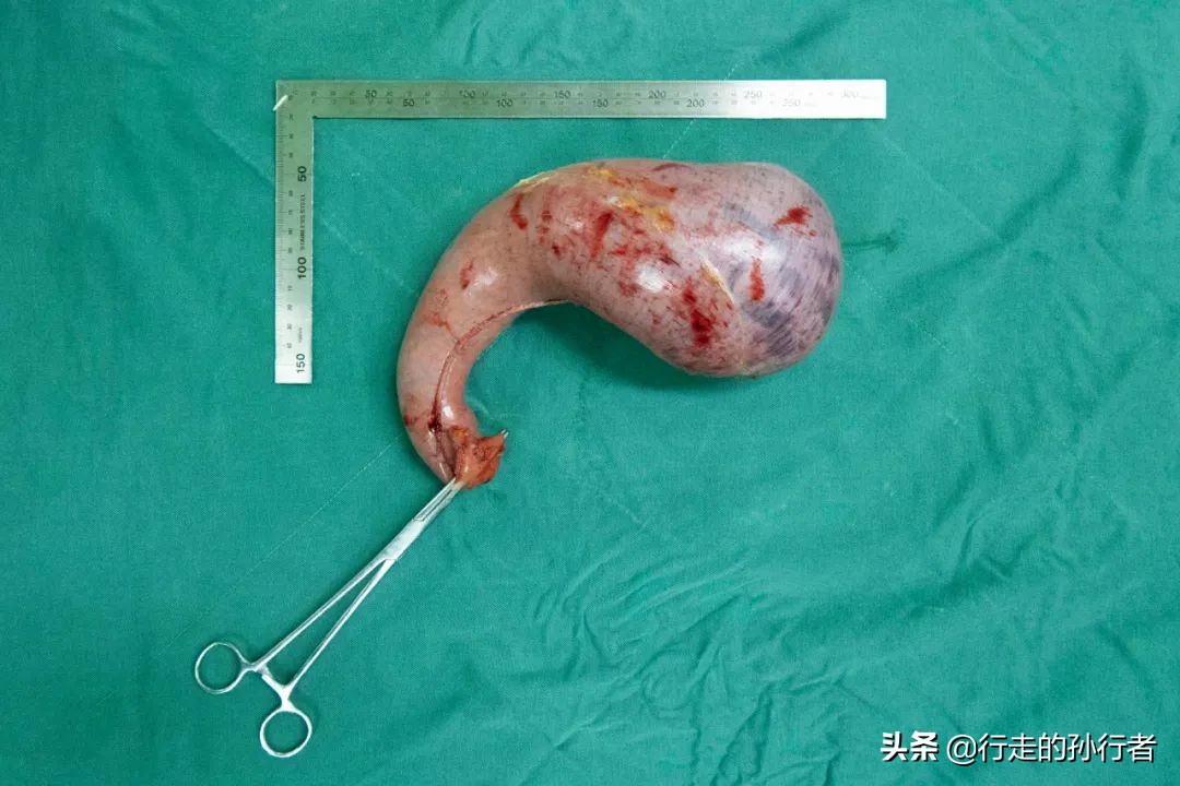 切胃减肥手术的副作用,为了减肥切胃到底值不值