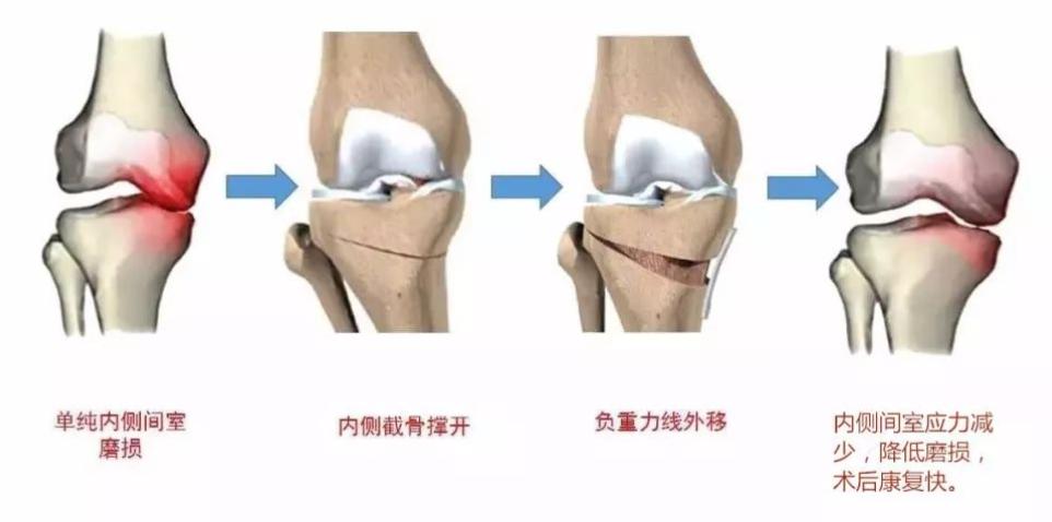 老年人膝关节退变原因,老年膝关节退变怎么治疗