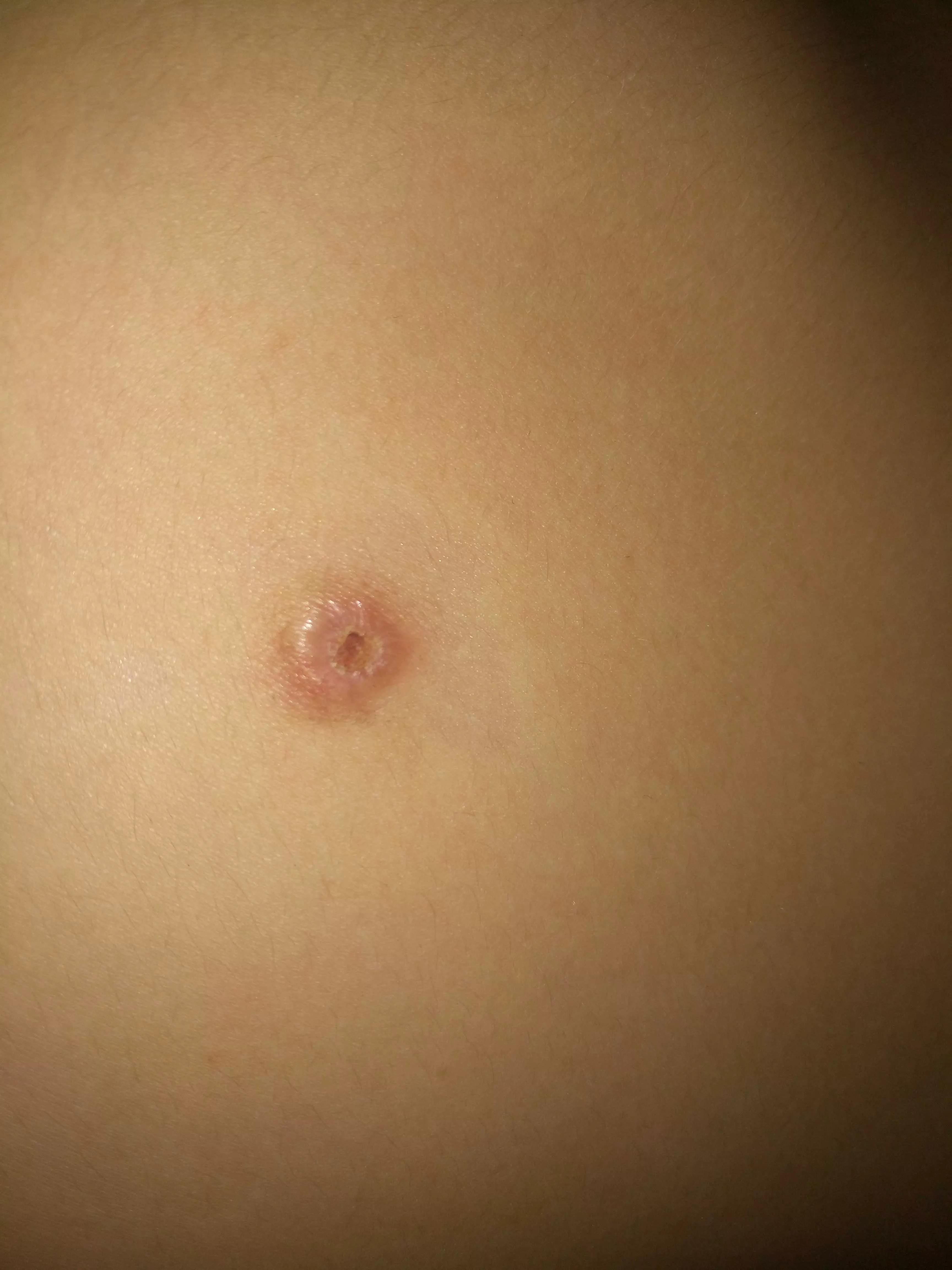 小孩身上有小黑点怎么回事,小孩身上小黑点越来越多