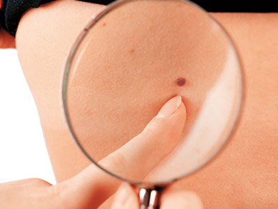 色素痣有可能恶变吗,哪些色素痣可能变为皮肤癌