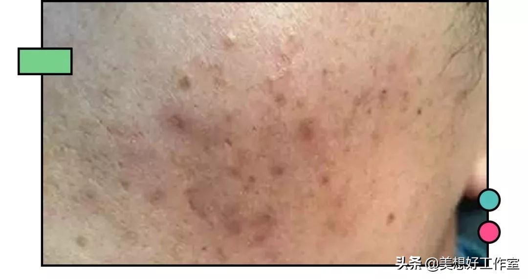 怎么祛痘印最有效简单方法,如何快速祛痘印最有效的方法