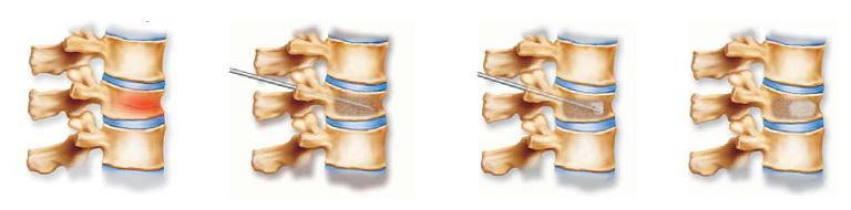 压缩性骨折做骨水泥微创,骨质疏松压缩性骨折打骨水泥